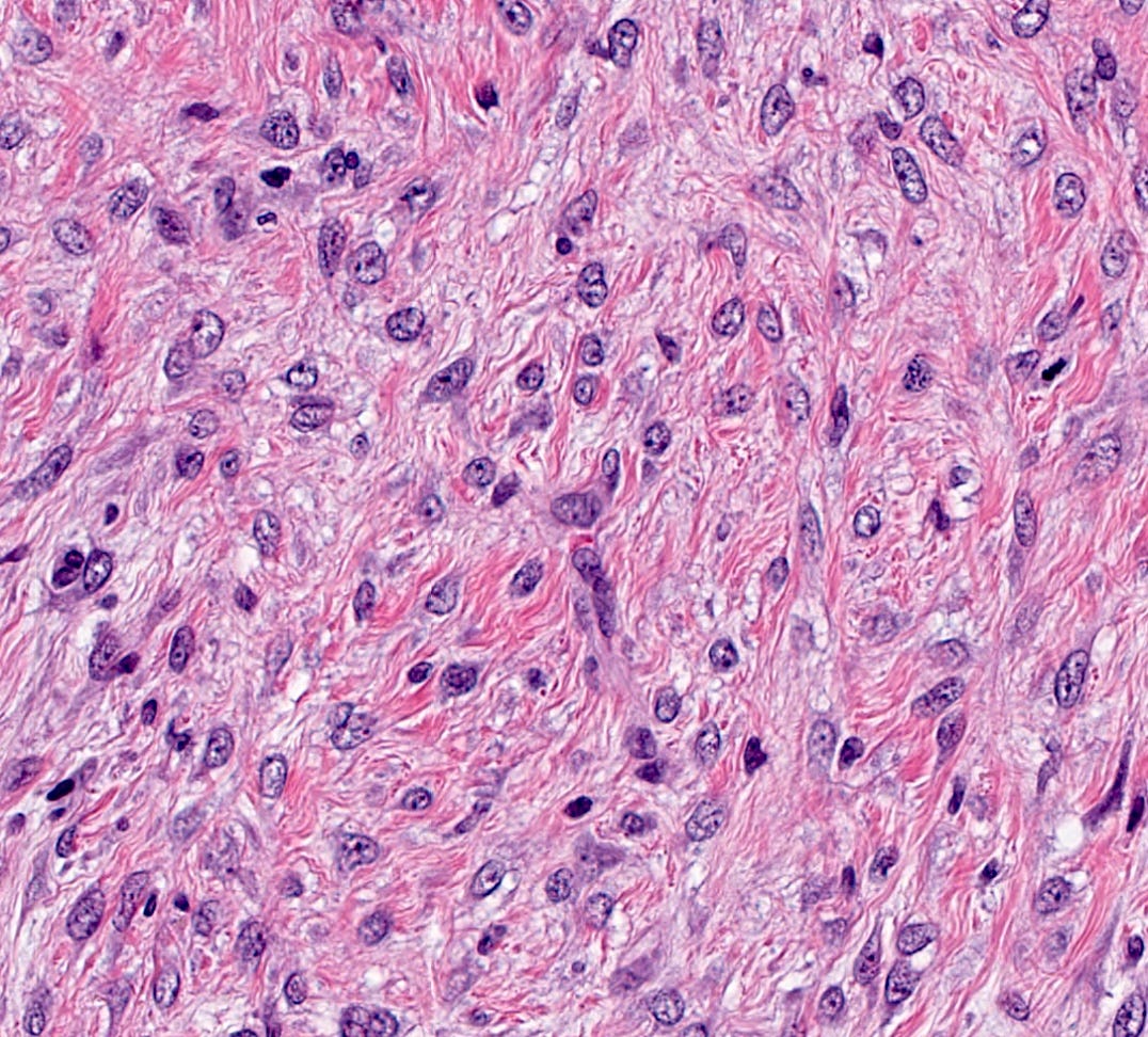 Round cells with nucleoli Round cells with nucleoli