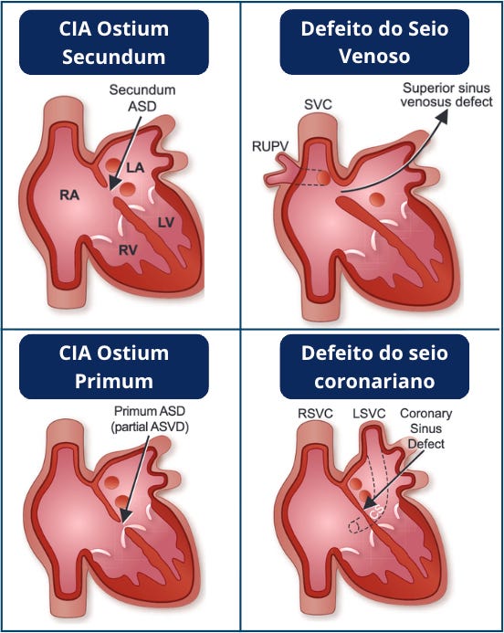 Comunicação interatrial (CIA) em adultos