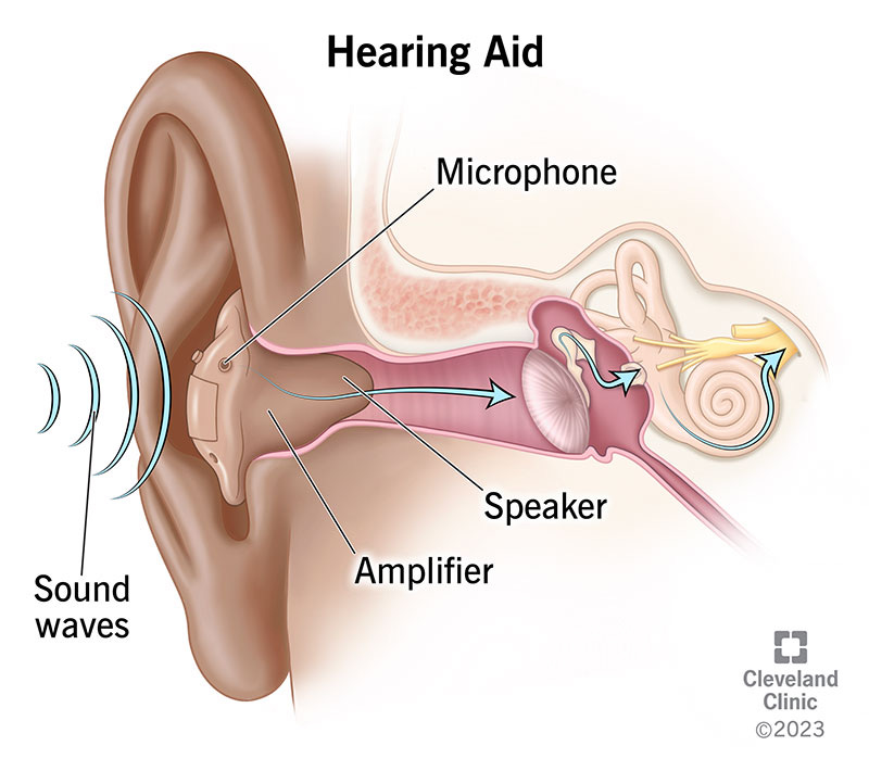 Hearing Aids: Uses & How They Work