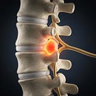 This is Why You Have a Bulging Disc