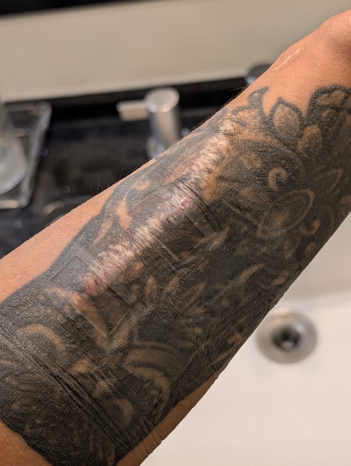 Dialysis treatment arm tattoo