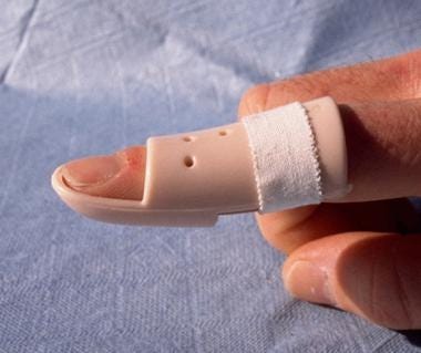 Mallet Finger Splint