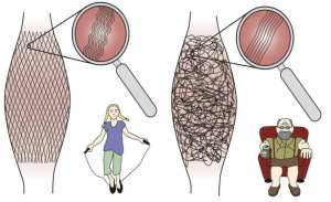 A young person's healthy fascia looks smooth, while an older person's unhealthy fascia looks wrinkled