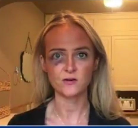 A person with a black eye

AI-generated content may be incorrect.