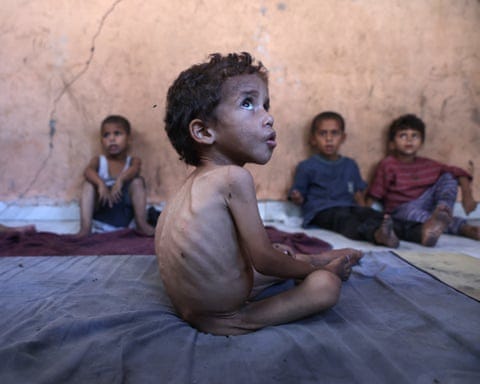 Yazan, a malnourished 2-year-old Palestinian boy, in the Al-Shati refugee camp, west of Gaza City. Yazan, a malnourished 2-year-old Palestinian boy, in the Al-Shati refugee camp, west of Gaza City.