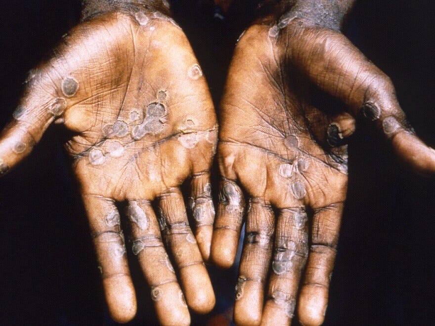 The palms of a patient with mpox during an outbreak in the Democratic Republic of Congo in 1997. The country is now seeing a dramatic spike in mpox — with a strain that is deadlier than the one that sparked the global outbreak in 2022. The palms of a patient with mpox during an outbreak in the Democratic Republic of Congo in 1997. The country is now seeing a dramatic spike in mpox — with a strain that is deadlier than the one that sparked the global outbreak in 2022.