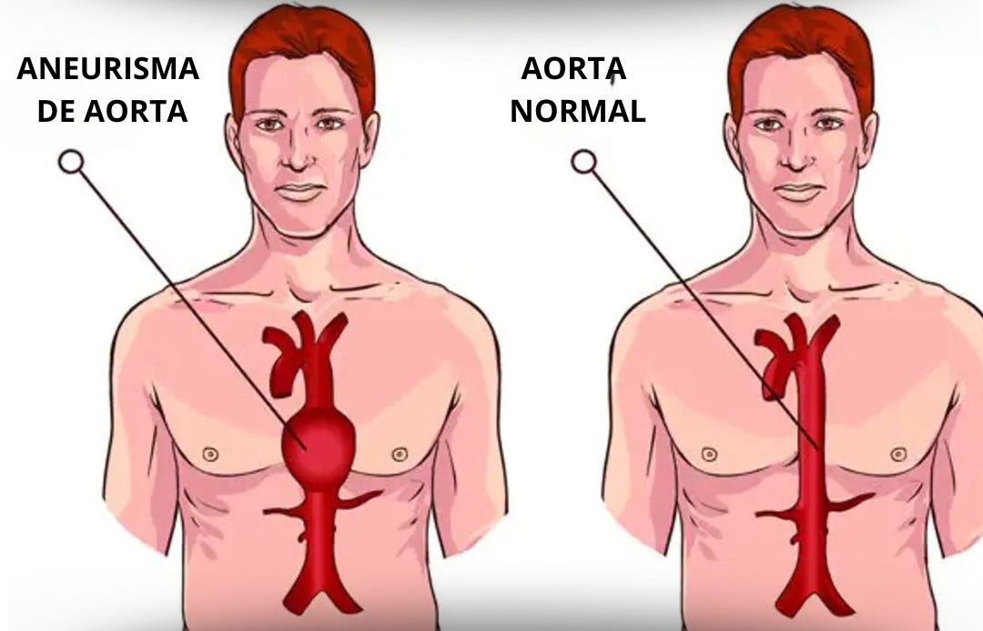 Aneurisma de aorta: o que é, sintomas, tipos e tratamento