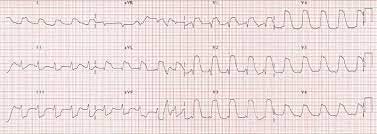 anterior STEMI with tombstone morphology | Medical education, Emergency  medicine, Ecg interpretation