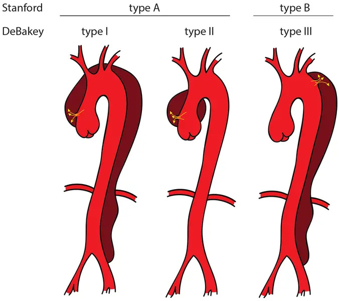 Aortic Dissection Symptoms