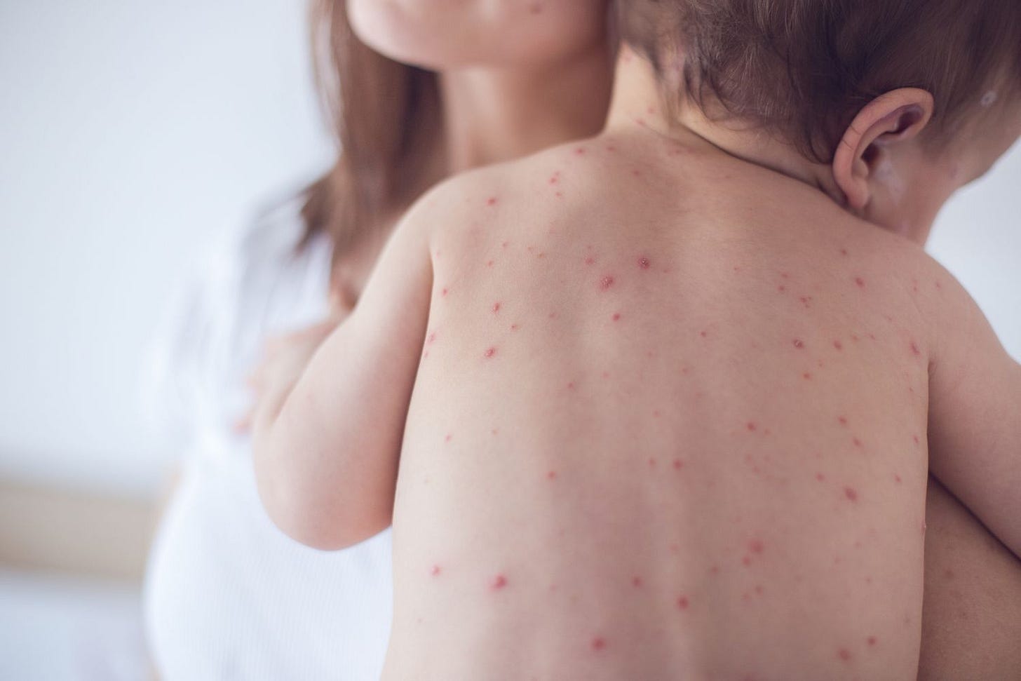 What to Do if You or Your Child Gets the Measles What to Do if You or Your Child Gets the Measles