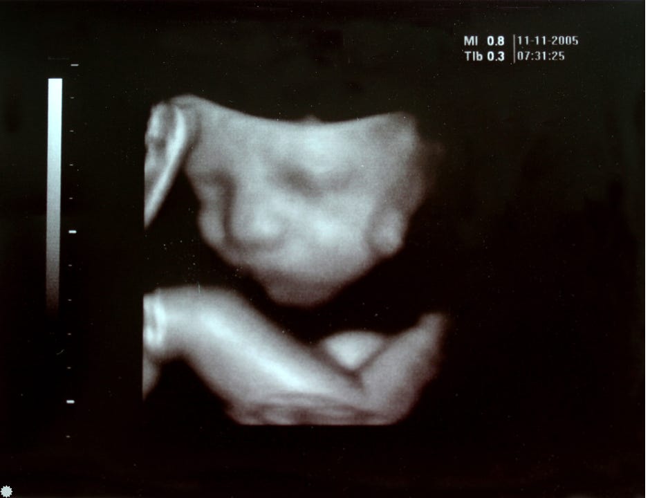 Black and white 3d ultrasound of preborn baby