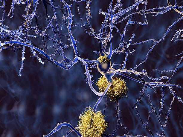 Alzheimer Disease Neurons With Amyloid Plaques Stock Photo - Download Image  Now - Amyloid, Alzheimer's Disease, Microglia - iStock
