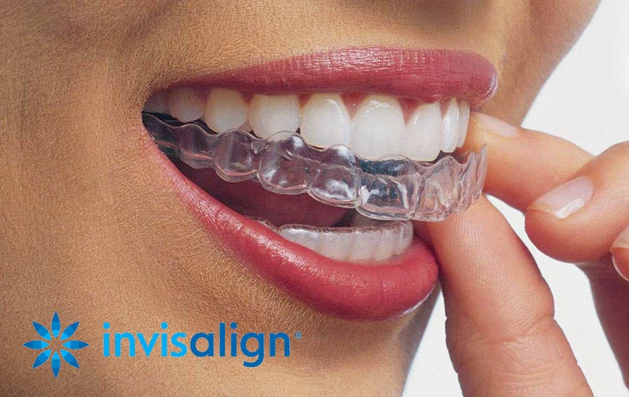 Invisalign® Trays | Centre dentaire Champel | Geneva