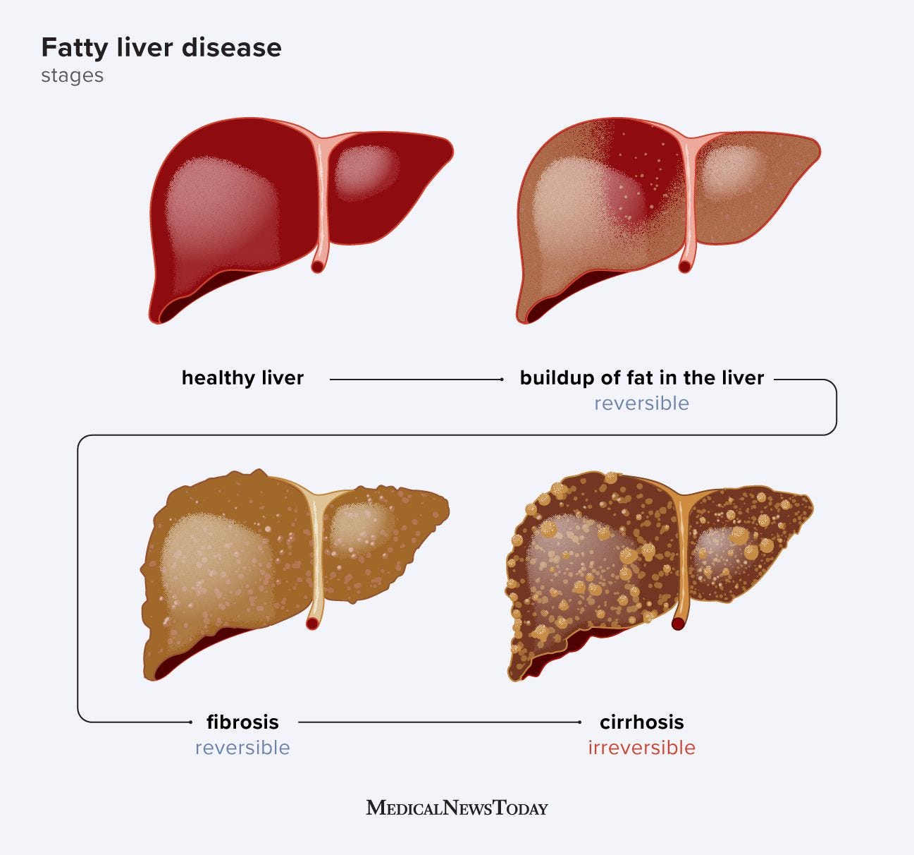 Fatty liver disease: Causes, symptoms, treatment, outlook