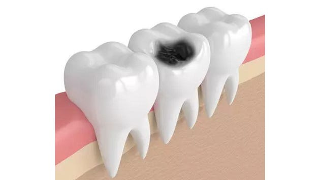 Tooth Infections