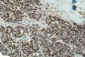 Treatment-resistant prostate cancer