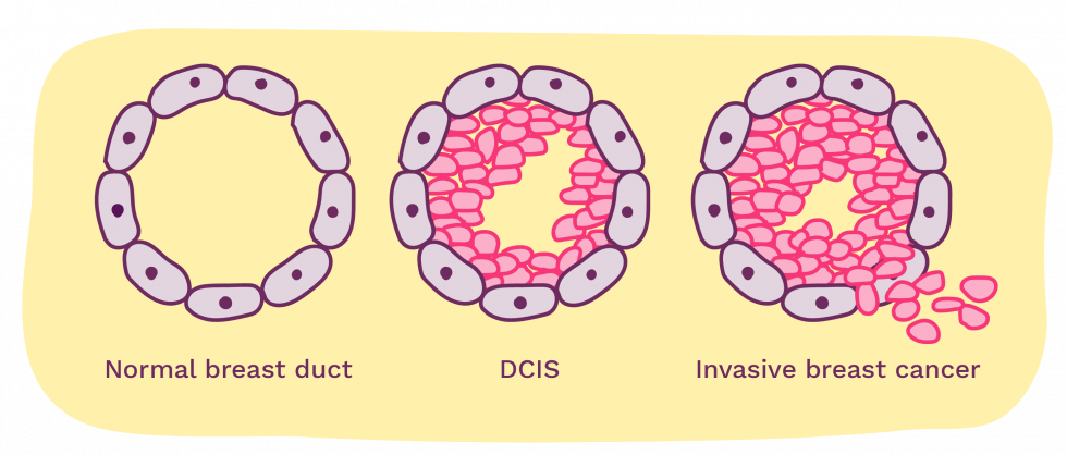 breast ducts