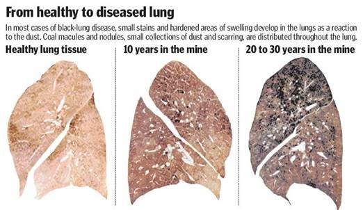 About Black Lung — Lungs At Work