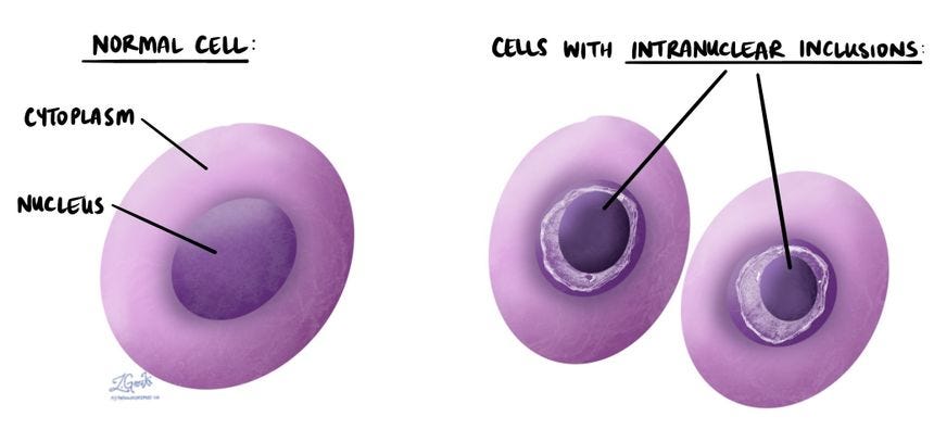 Intranuclear inclusions