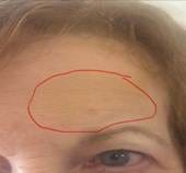 A Palm Tree Frond Fell on My Forehead