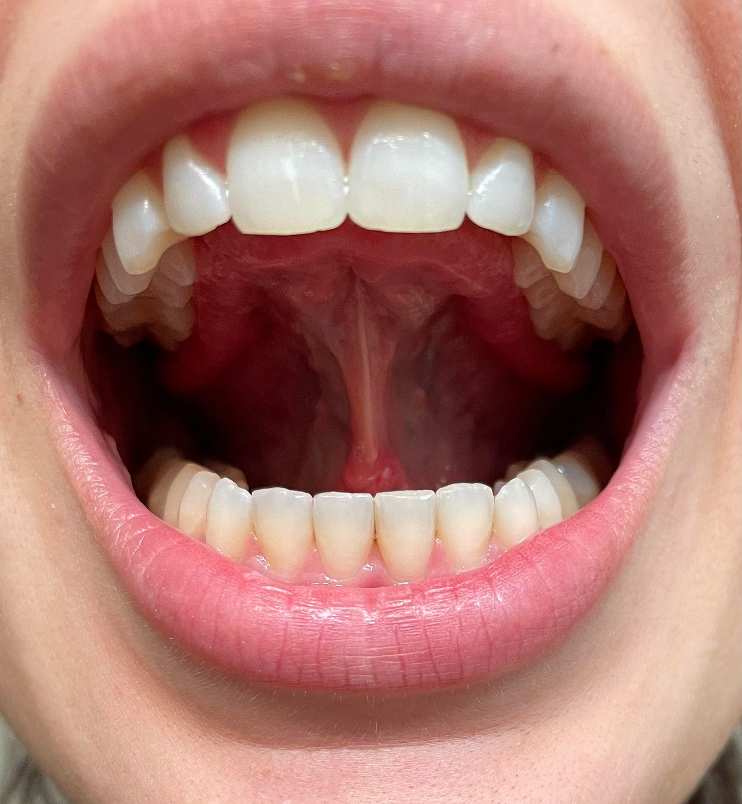 Tongue tie or normal? : r/orthotropics