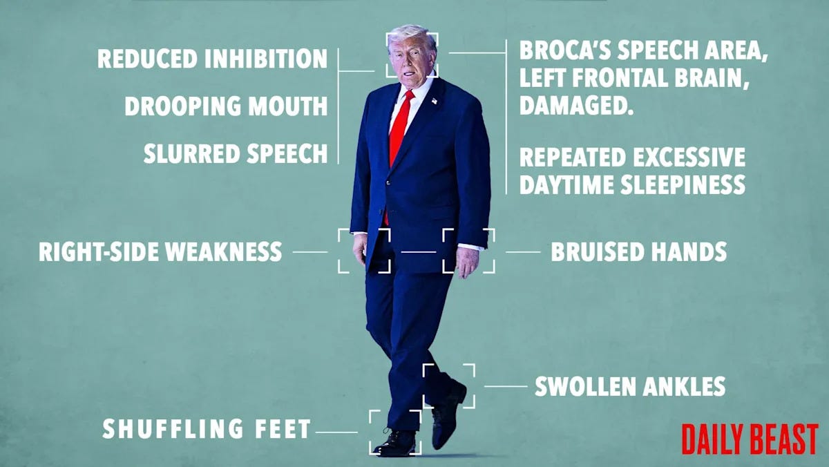 Opinion: These Are the Physical and Mental Signs Trump Has Had a Stroke:  Doctor