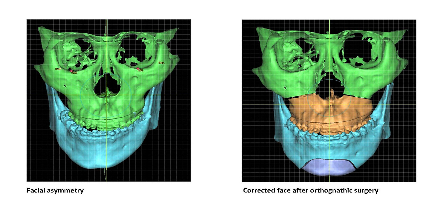 Study finds facial asymmetry correction surgery effective in relieving syndrome of jaw joint pain patients