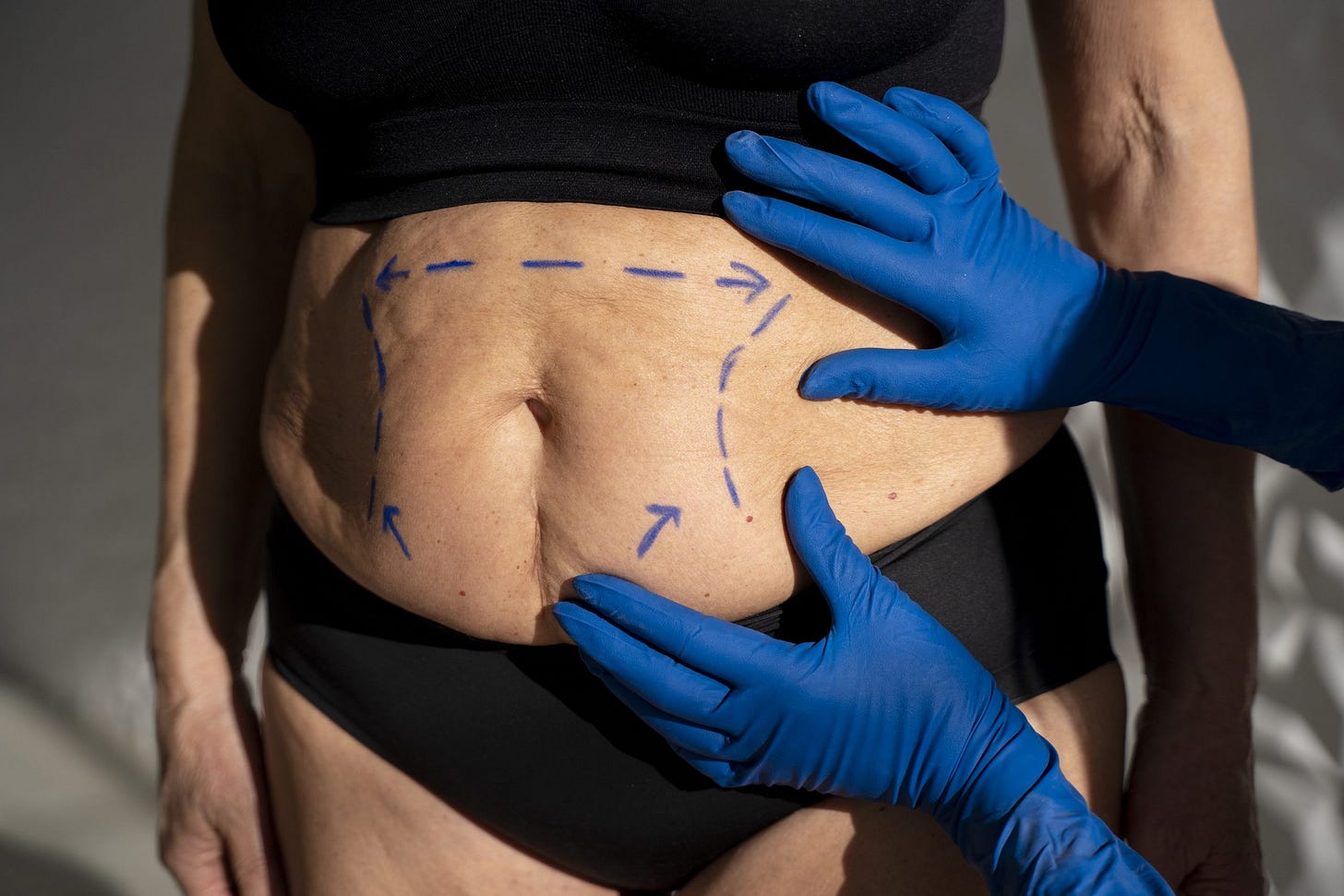 Bariatric Surgery - Healthy Support and Aesthetic