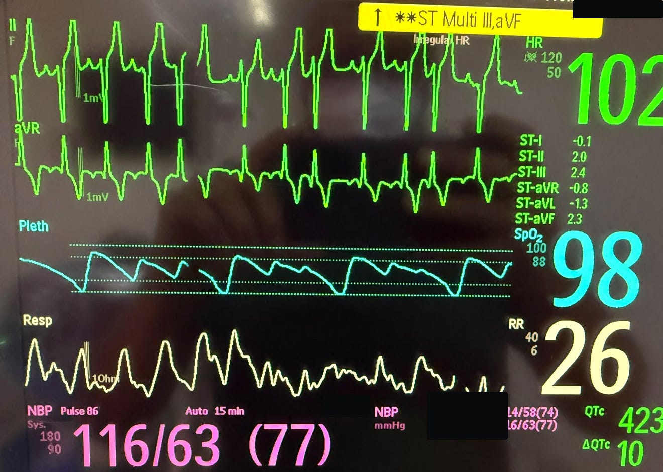 Registro inicial desidentificado de monitorización perioperatoria con trazados eléctricos, frecuencia cardiaca, presión arterial, pletismografía y saturación. Documenta el estado inicial del monitor, sin identificar por sí solo la causa de las alteraciones.
