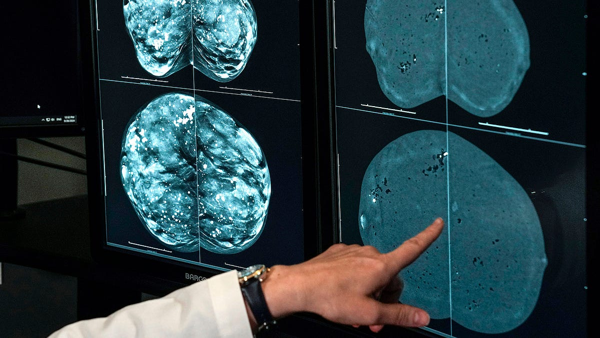 A non-scary look at breast cancer now