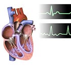 Atrial fibrillation
