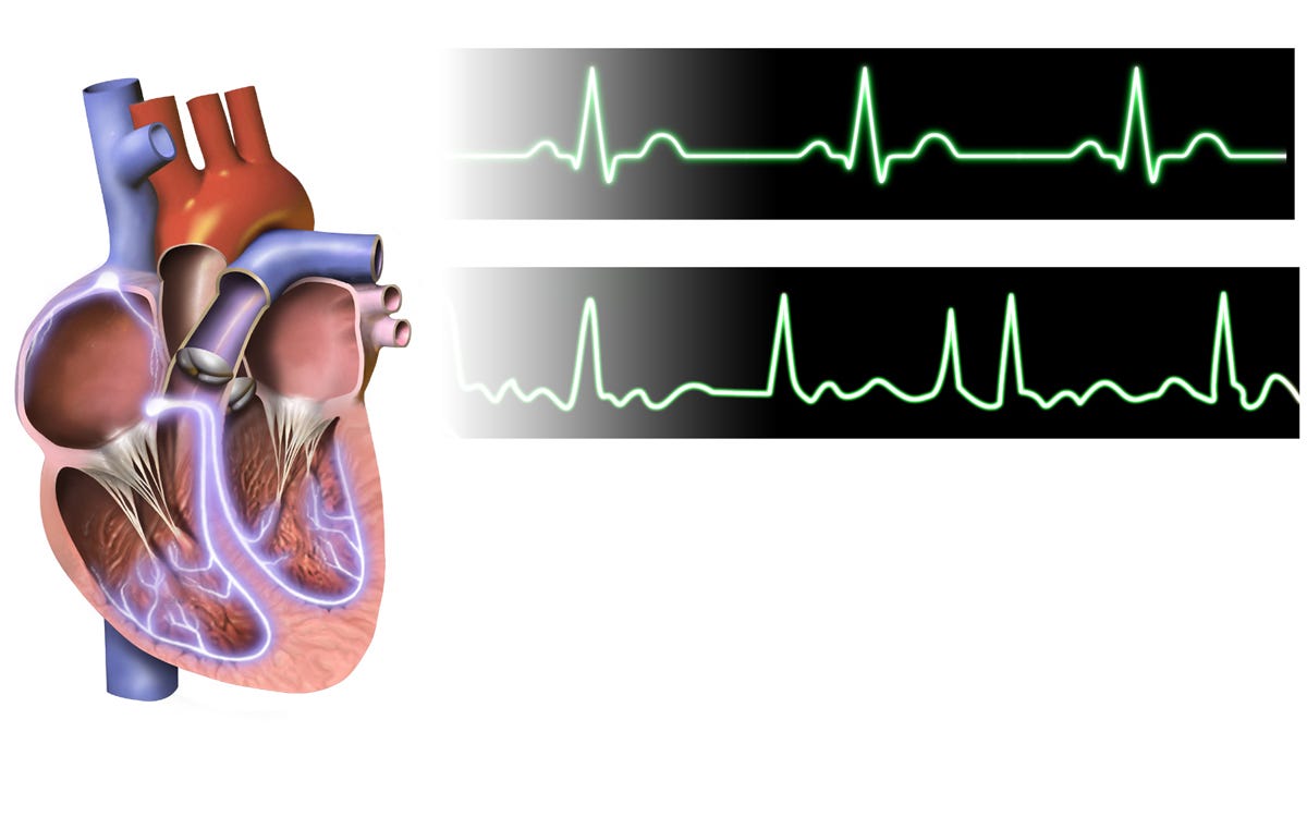 Sinus rhythm vs AF Sinus rhythm vs AF