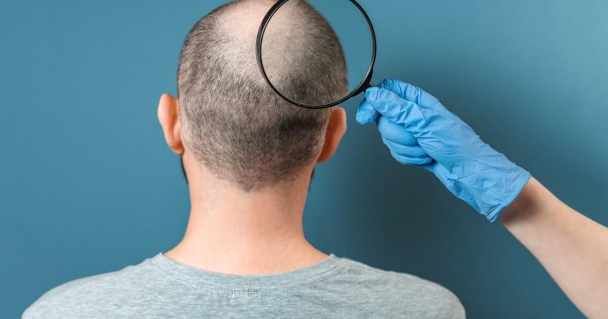Sinais de calvície: quais são e como solucionar isso, confira! | Clínica Ser Cirurgia Plástica Funcional Sinais de calvície: quais são e como solucionar isso, confira! | Clínica Ser Cirurgia Plástica Funcional