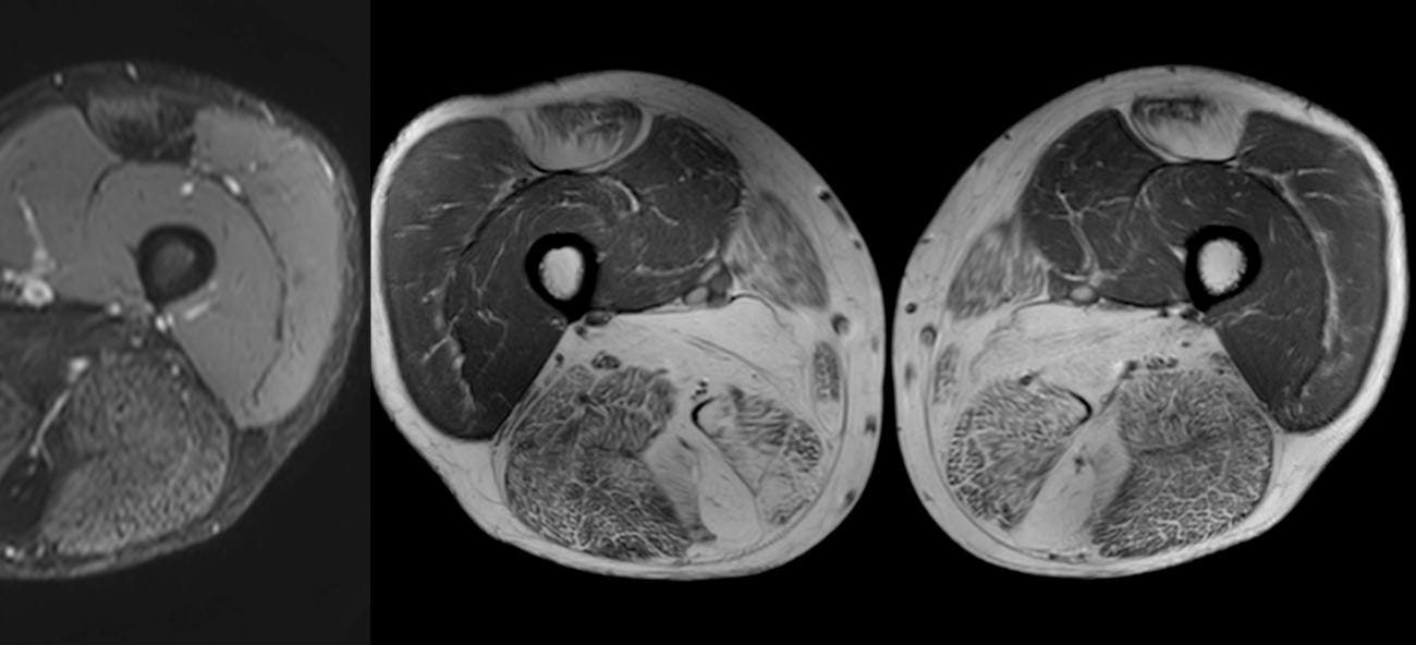 Case 63: The Honeycomb Pattern of Myositis