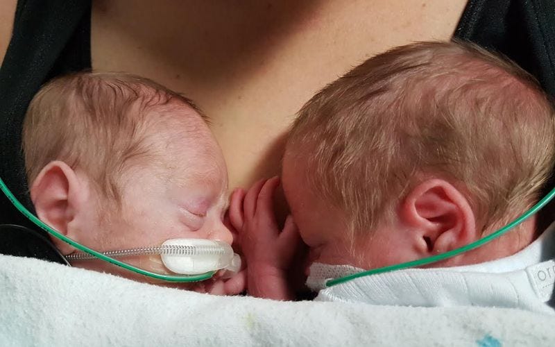3 sacs with surviving fraternal boy twins