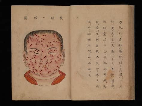 Smallpox illustration, Japanese manuscript, c. 1720 | Wellcome Collection
