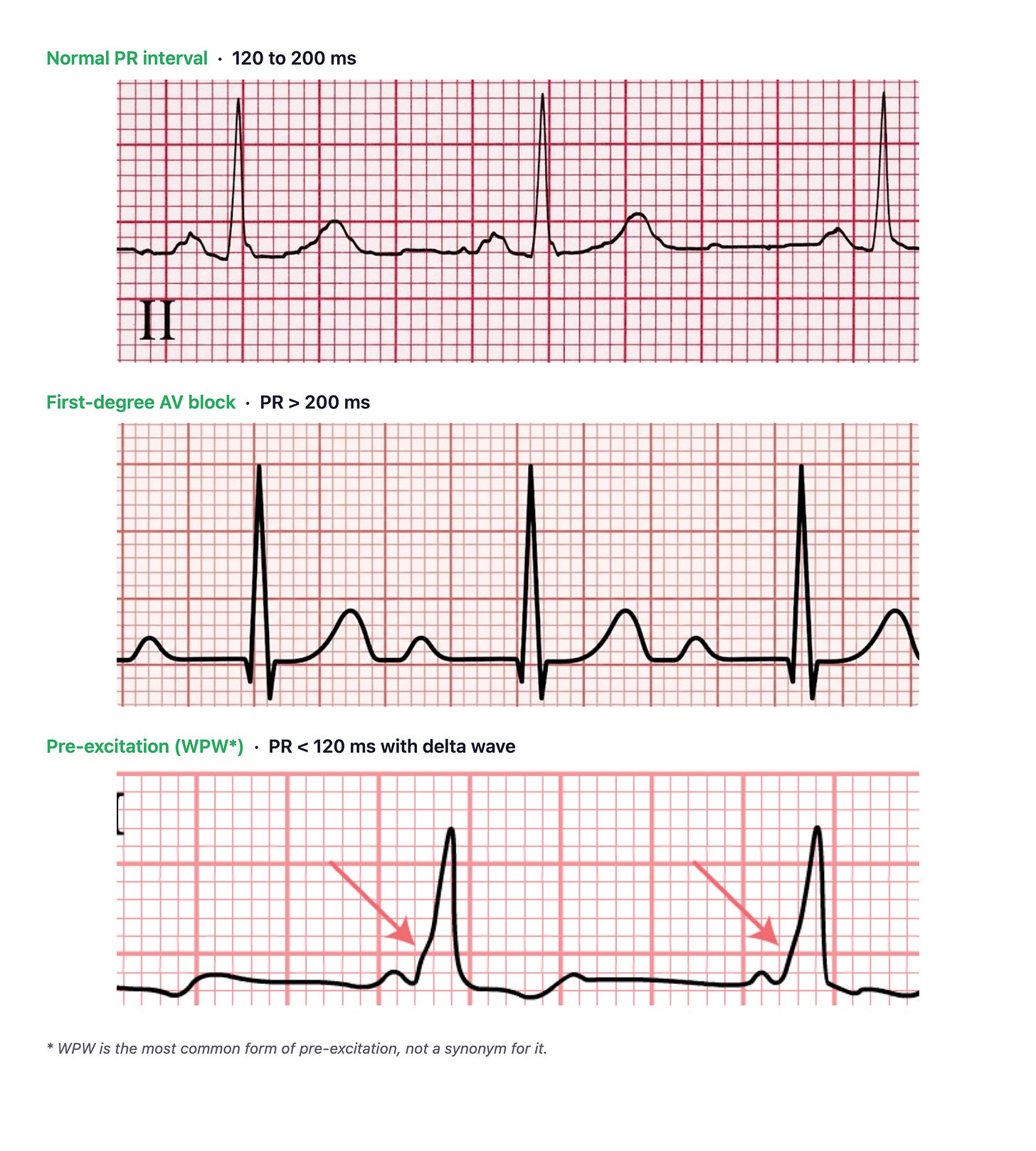 Three stacked rhythm strips labelled normal PR interval (120 to 200 ms), first-degree AV block (PR > 200 ms), and pre-excitation WPW (PR < 120 ms with delta wave)