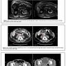 Fenbendazole & Cancer