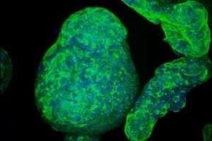 pancreatic tumor pancreatic tumor