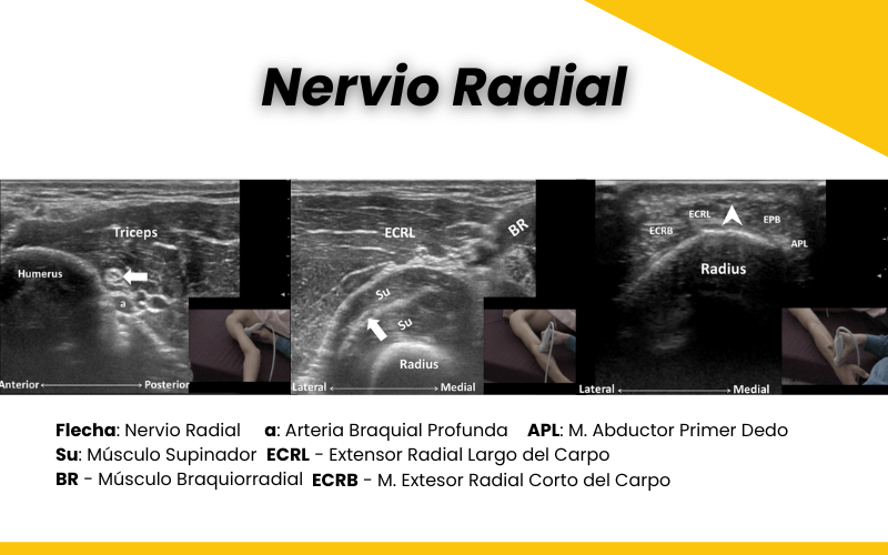 Nervio radial y ecografía - by Tempo Formación