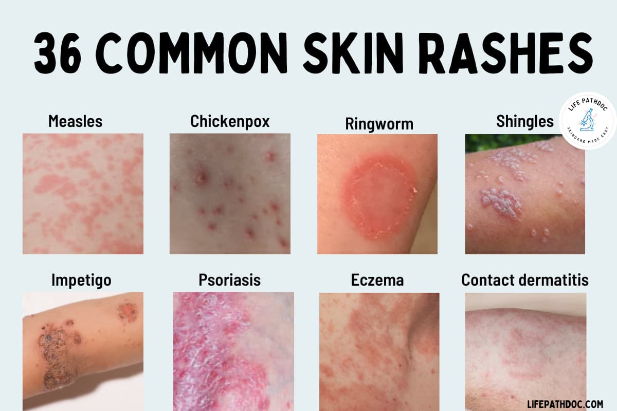 https://lifepathdoc.com/wp-content/uploads/2023/07/rashes-on-skin-2.jpg