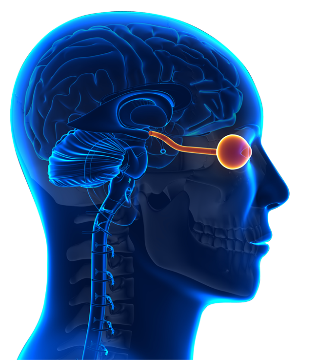 Neuromyelitis Optica Spectrum Disorder - ENDECE Neuromyelitis Optica Spectrum Disorder - ENDECE