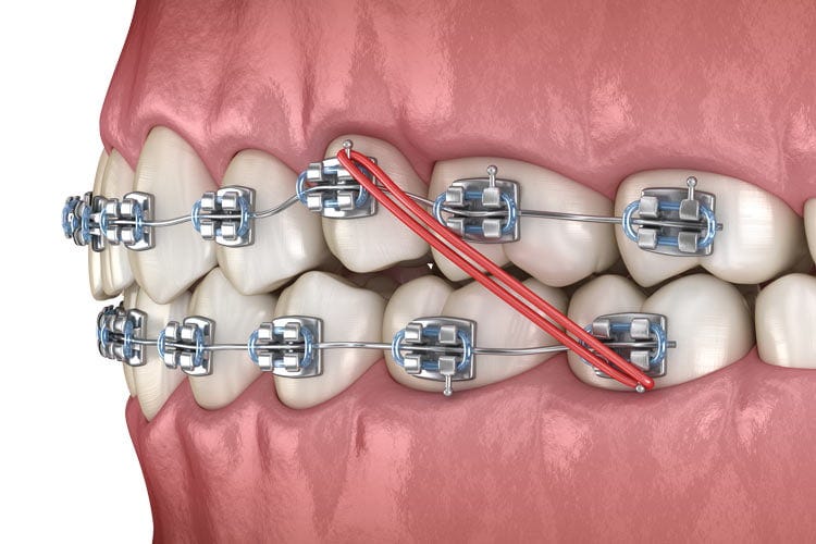 Orthodontics | Family Dentistry | Dental Health Associates | Madison
