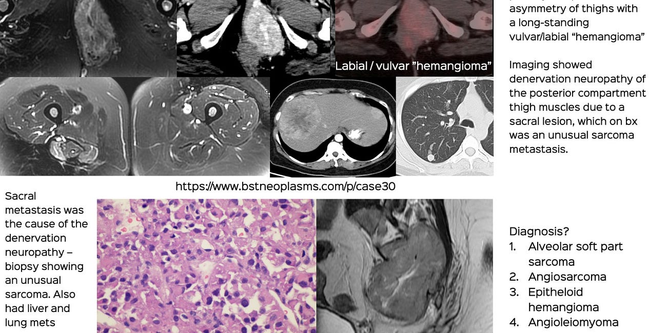 Case 30: The Misdiagnosed Labial Hemangioma