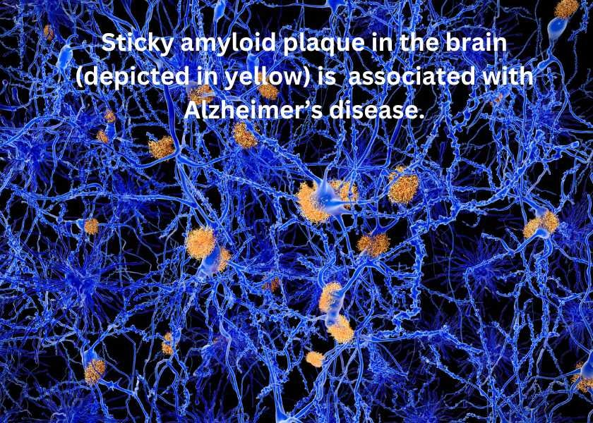 computer rendering of amyloid plaque in the brain computer rendering of amyloid plaque in the brain