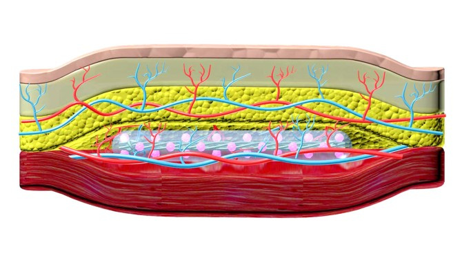 Illustration of diabetes implant