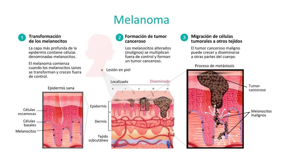 Melanoma | Hospital Ruber Internacional
