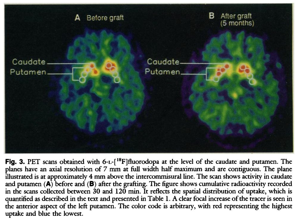 From Lindvall et al. 1990.