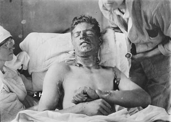 Mustard_gas Mustard gas burns