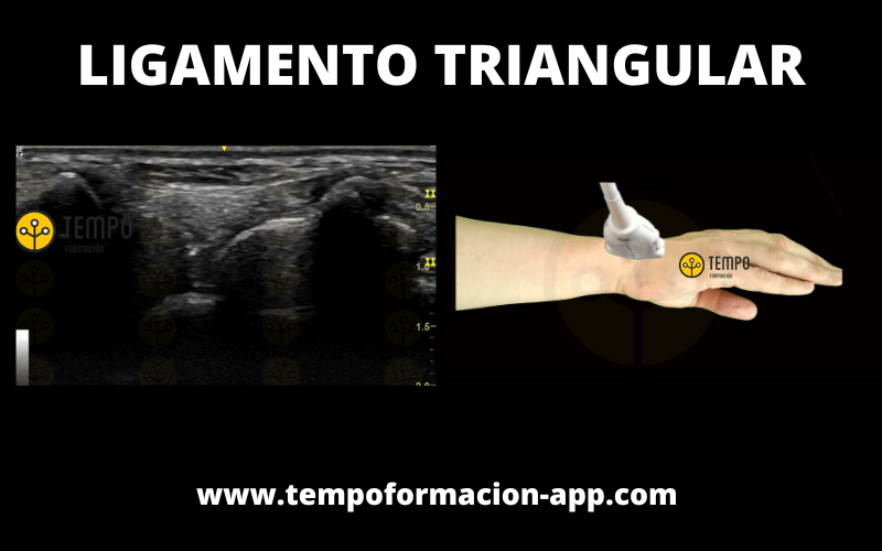 Ligamento Triangular Sonda Ecografia.png
